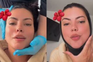 Fernanda Bande revela cirurgia no rosto e mostra recuperação